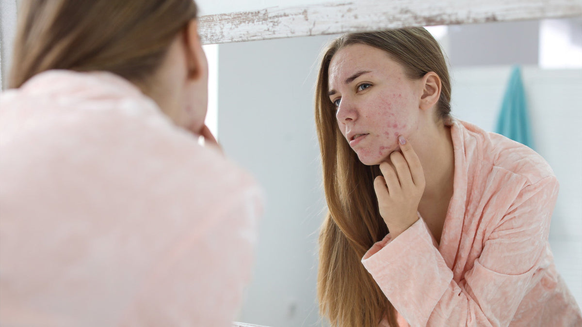 Woman with acne touching face while looking in the mirror