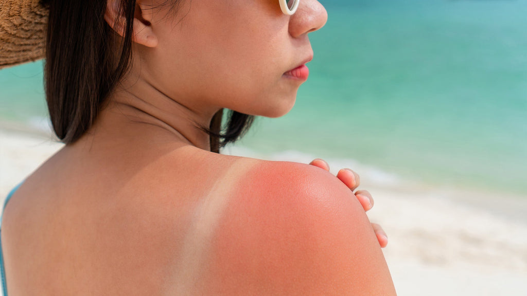 How to Care for Your Skin After a Sunburn: Fast Relief & Repair Guide