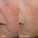Close-up before-and-after comparison of facial skin showing visible red veins under the eyes, labeled 'BEFORE' on the left and 'AFTER 12 WEEKS' on the right.