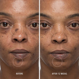 InnerDerm Rx Refill