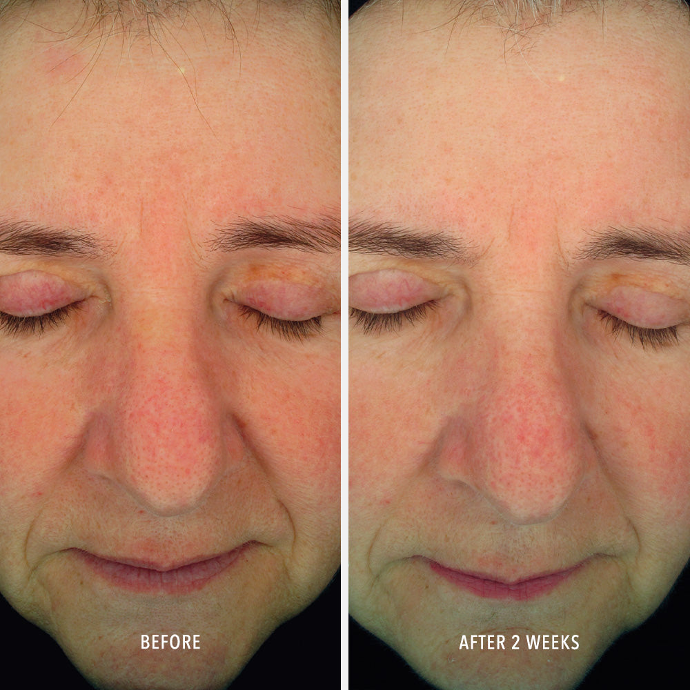 HydroPeptide Soothing Serum before and after