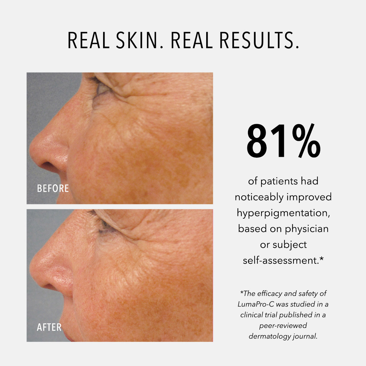 HydroPeptide LumaPro-C Serum before and after with statistical results
